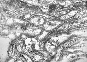 M,15y. | neurinoma n. optici M,15y. | neurinoma n. optici